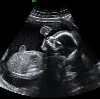 photo polsono mobile ultrasound